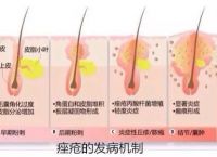 你发现了吗？青春痘永远都是对称长的，原来是因为这个原因！三年的长痘谜底终于揭开了